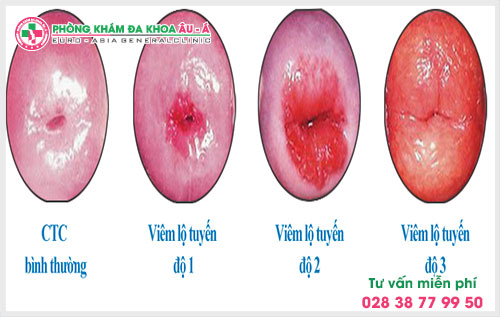 Những nguy hại và biến chứng của viêm cổ tử cung