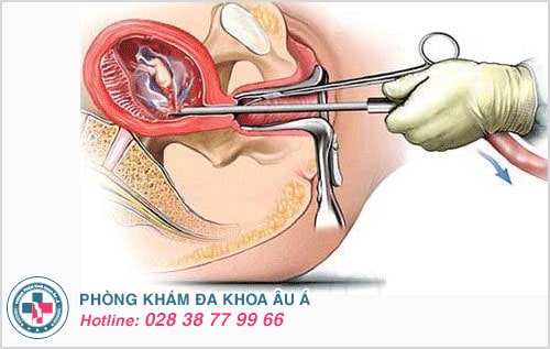 phá thai lớn