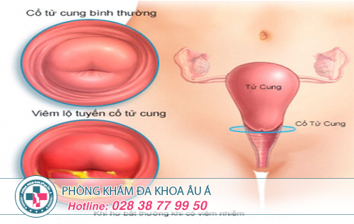 Phương pháp dao LEEP trị viêm lộ tuyến