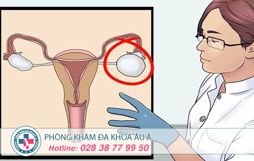 Phương pháp điều trị u nang buồng trứng hiệu quả