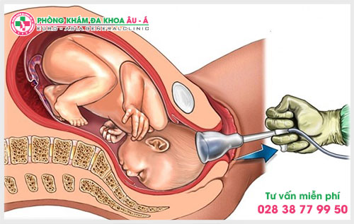 Phương pháp hút thai là gì