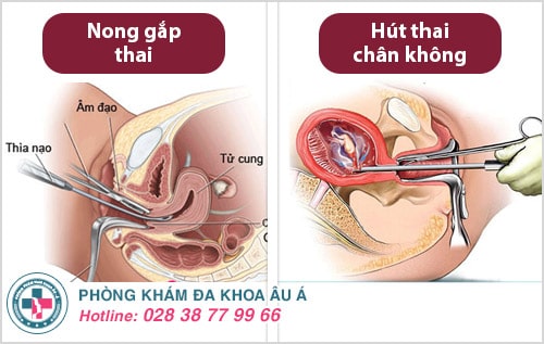 3 phương pháp phá thai không đau hiện nay