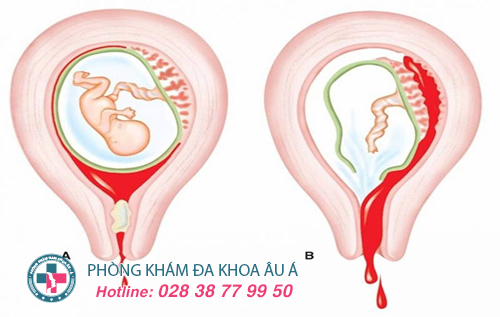 Cẩn thận với sót thai, sót nhau sau khi phá thai