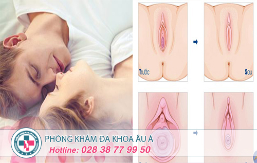 Thu hẹp âm đạo - lấy lại thanh xuân cho 