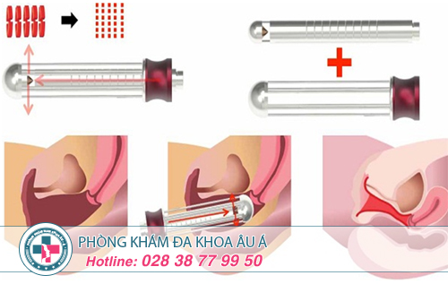 Sự thật về phương pháp thu hẹp vùng kín không phẫu thuật