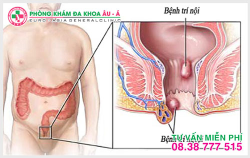 Nguyên nhân nào dẫn đến bệnh trĩ ngoại