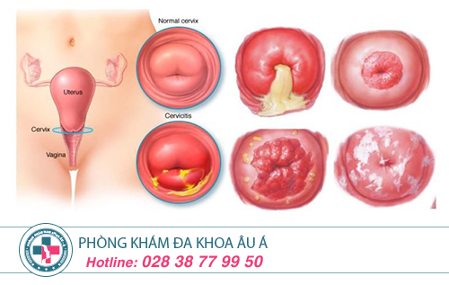Triệu chứng viêm lộ tuyến cổ tử cung bạn đã biết chưa?
