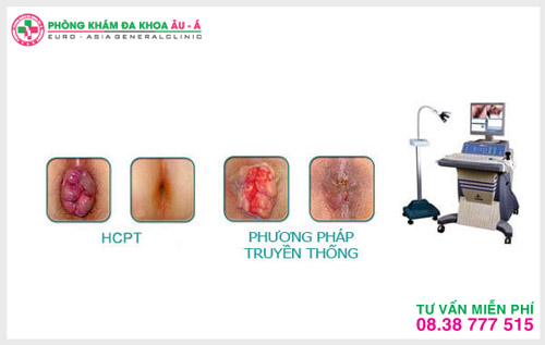 HCPT hỗ trợ điều trị trĩ ngoại hiệu quả, ít đau, thẫm mỹ