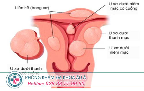 U xơ tử cung khám ở đâu?