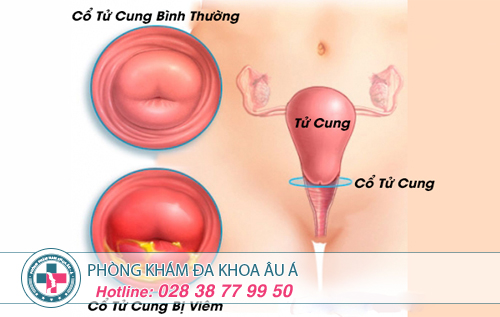 7 dấu hiệu nhận biết viêm cổ tử cung