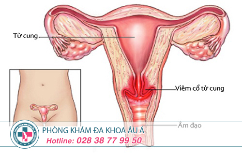 Viêm cổ tử cung - Nguyên nhân, triệu chứng và cách điều trị hiệu quả