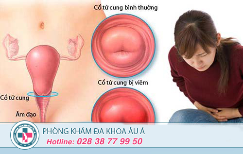 Viêm lộ tuyến cổ tử cung điều trị ở đâu?