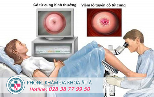 Viêm lộ tuyến cổ tử cung sau sinh