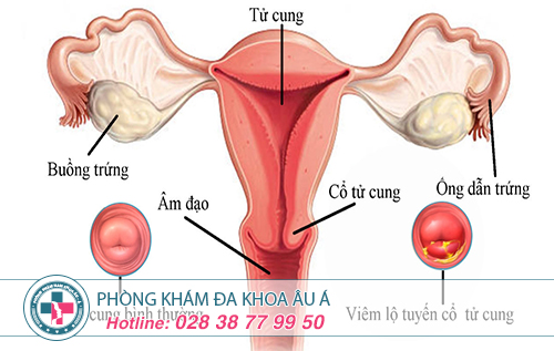 Viêm lộ tuyến cổ tử cung triệu chứng