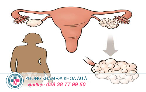 Viêm ống dẫn trứng có thể dẫn tới vô sinh