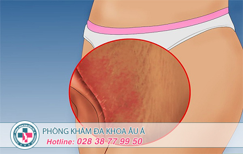 Vùng kín bị sưng đỏ và rát là chuyện gì?
